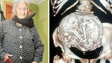 Una anciana lleva un feto momificado en su vientre