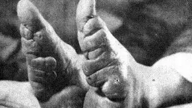 "Pies de loto" para la mujeres chinas "Pies de loto" para la mujeres chinas