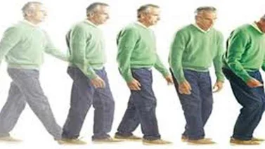 La estimulación intracraneal podría reducir el parkinson