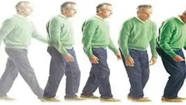 La estimulación intracraneal podría reducir el parkinson La estimulación intracraneal podría reducir el parkinson