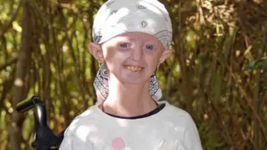 A los 17 años murió la adolescente "más vieja del mundo" A los 17 años murió la adolescente "más vieja del mundo"