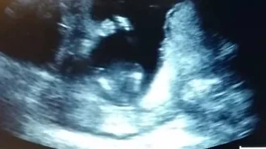 Bebé de 14 semanas de gestación aplaude durante una ecografía (Video)