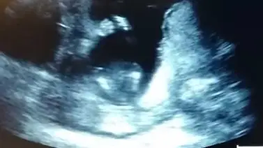 Bebé de 14 semanas de gestación aplaude durante una ecografía (Video) Bebé de 14 semanas de gestación aplaude durante una ecografía (Video)