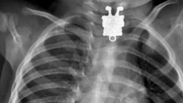 Bob Esponja fue encontrado en el cuello de un niño