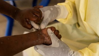 Registran el primer caso de viruela del mono fuera de África