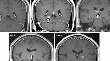 Pasó 4 años con un parásito en su cerebro Pasó 4 años con un parásito en su cerebro