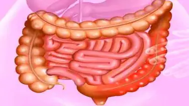 ¿Qué es la sigmoiditis, la infección que aqueja a Cristina Fernández? ¿Qué es la sigmoiditis, la infección que aqueja a Cristina Fernández?