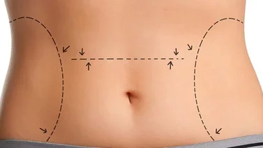 Lipoescultura: Método efectivo para moldear la figura