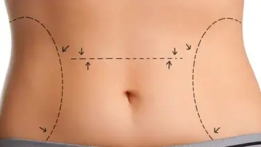 Lipoescultura: Método efectivo para moldear la figura Lipoescultura: Método efectivo para moldear la figura