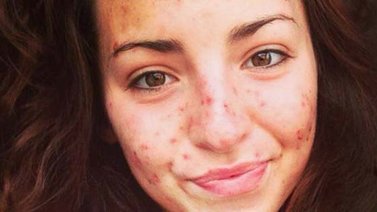 La rara enfermedad de no poder dejar de pellizcarse