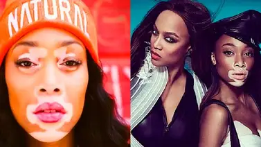 Sufre de vitíligo pero no le impidió luchar para ser modelo Sufre de vitíligo pero no le impidió luchar para ser modelo