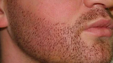 El implante de barba hace furor en Nueva York