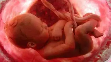 Una anciana de 84 años lleva dentro un feto desde hace 44 años Una anciana de 84 años lleva dentro un feto desde hace 44 años