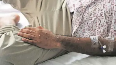 Mpox: Cuatro países de Latinoamérica anuncian estas medidas de protección Mpox: Cuatro países de Latinoamérica anuncian estas medidas de protección