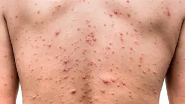 ¿Cuáles son los tratamientos disponibles para la viruela del mono? ¿Cuáles son los tratamientos disponibles para la viruela del mono?