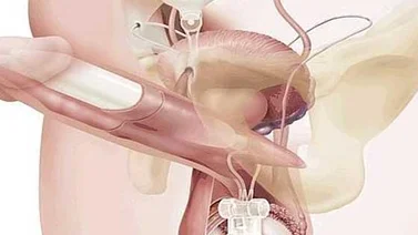 Una prótesis de pene le hace mantener una erección durante 8 meses
