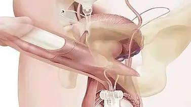 Una prótesis de pene le hace mantener una erección durante 8 meses Una prótesis de pene le hace mantener una erección durante 8 meses