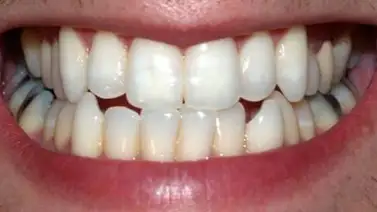 ¿Sabes qué es la dentera? ¿Sabes qué es la dentera?