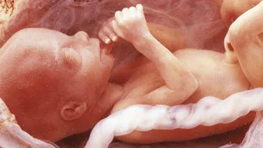 Estudios realizados con células madres podría curar la hidrocefalia en fetos