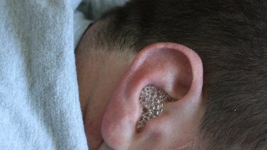 ¿Es bueno limpiar los oídos con agua oxigenada? Entérate aquí