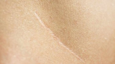 Cicatrices | Remedios naturales para aclararlas