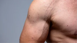 ¡Atención, hombres! Así puedes disimular tus estrías: conoce los métodos naturales que puedes usar en casa a muy bajo costo