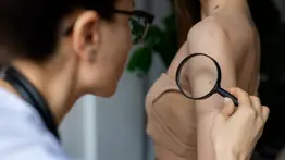 ¡Alerta por cáncer de piel! Dermatólogos preden las alarmas por una moda viral entre los jóvenes: provoca graves daños