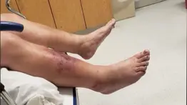 bacteria "come carne" luisiana estados unidos ee.uu