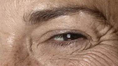 Susana Misticone: El melasma es testarudo, pero nosotros lo ayudamos a empeorar Susana Misticone: El melasma es testarudo, pero nosotros lo ayudamos a empeorar