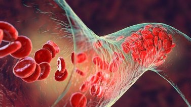 Crean células madre sanguíneas para ayudar con la leucemia