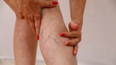 ¿Varices? Aquí te decimos cómo reducirla con remedios caseros