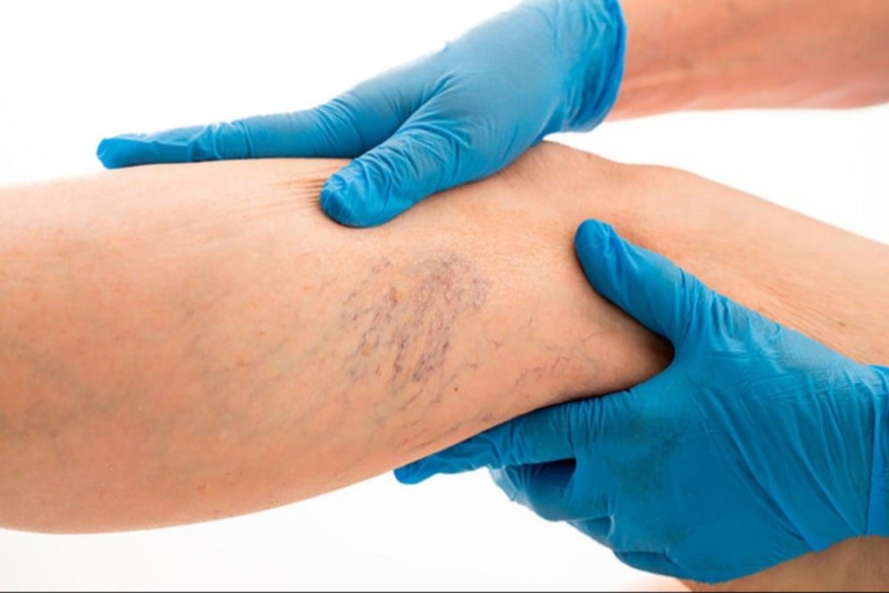 ¿Varices? Aquí te decimos cómo reducirla con remedios caseros ¿Varices? Aquí te decimos cómo reducirla con remedios caseros