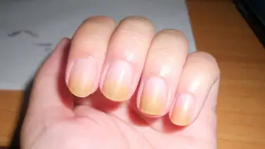 Ese color amarillo en las uñas puede ser síntoma de esta enfermedad Ese color amarillo en las uñas puede ser síntoma de esta enfermedad