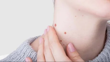 Remedios caseros para quitar las verrugas del cuello