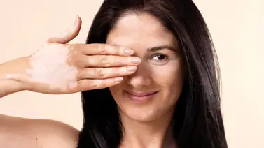 Elimina las manchas de la piel con esta fórmula casera a base de limón: sigue estos pasos para prepararla Elimina las manchas de la piel con esta fórmula casera a base de limón: sigue estos pasos para prepararla