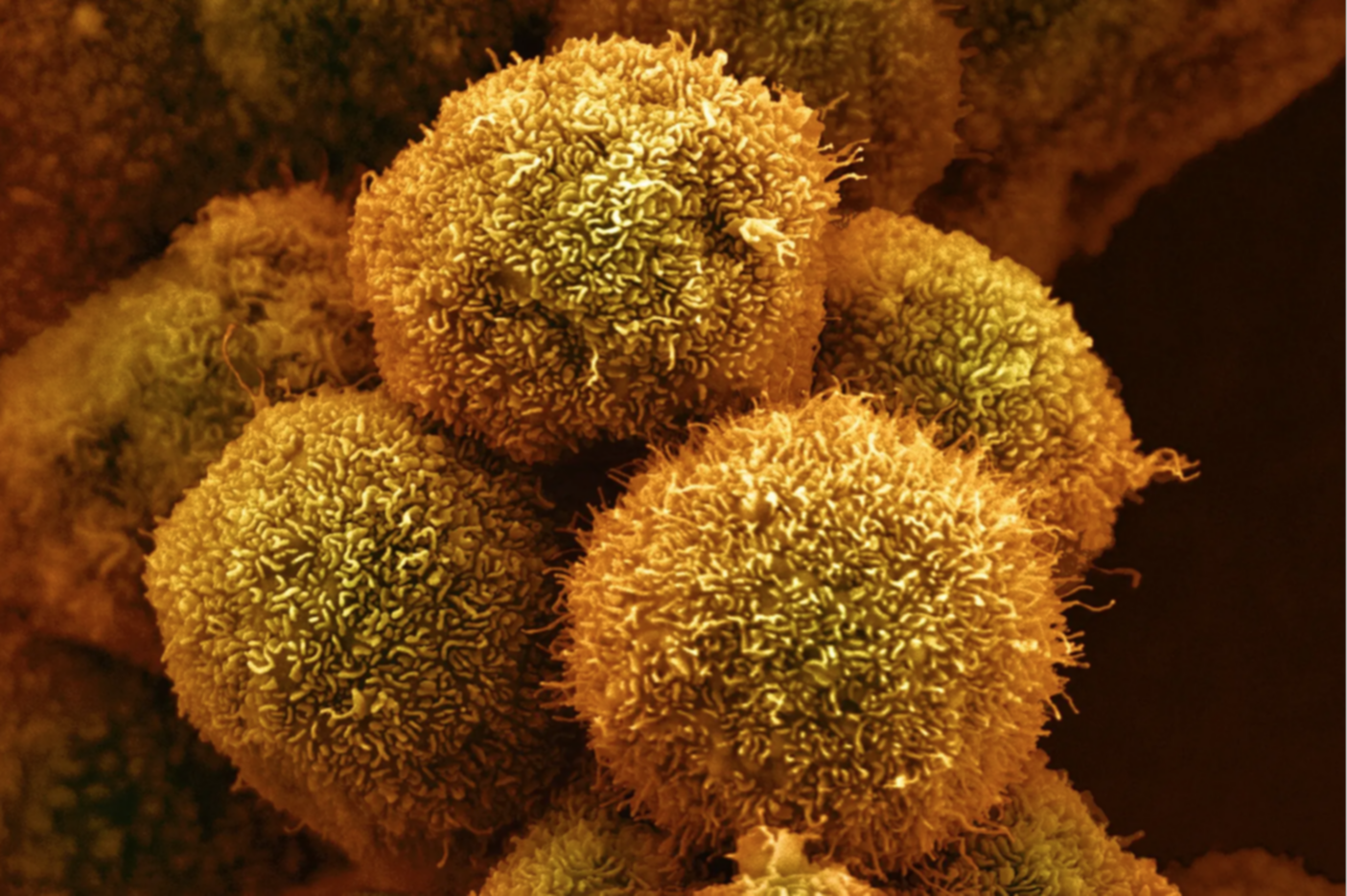 Avance de la medicina moderna: el fármaco que ofrece nueva esperanza contra el cáncer de páncreas Avance de la medicina moderna: el fármaco que ofrece nueva esperanza contra el cáncer de páncreas