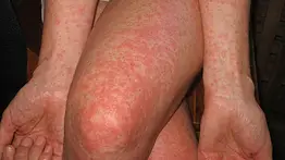 Salud pública en Florida: proponen autorizar a farmacéuticos para aplicar la vacuna contra el chikunguña