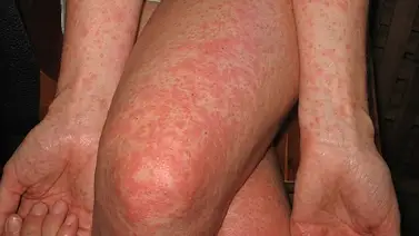 Salud pública en Florida: proponen autorizar a farmacéuticos para aplicar la vacuna contra el chikunguña Salud pública en Florida: proponen autorizar a farmacéuticos para aplicar la vacuna contra el chikunguña