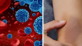 California | Lanzan apoyo y recursos para pacientes con cáncer de sangre