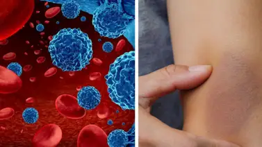 California | Lanzan apoyo y recursos para pacientes con cáncer de sangre California | Lanzan apoyo y recursos para pacientes con cáncer de sangre