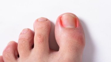 ¿Tienes un uñero? Así puedes curarlo en casa