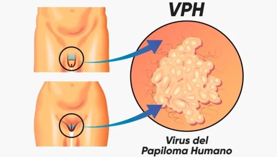 Gobierno nacional impulsa proyecto de investigación para detección del VPH