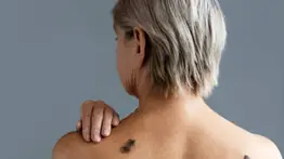 Elimina las manchas de la piel con esta fórmula casera a base de limón: aprende a prepararla