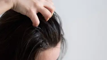 ¡Adiós caspa! Esta es la mascarilla natural que elimina cualquier impureza del cabello: solo necesitas tres ingredientes ¡Adiós caspa! Esta es la mascarilla natural que elimina cualquier impureza del cabello: solo necesitas tres ingredientes