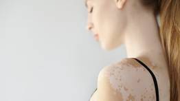 Elimina las manchas de la piel con esta milagrosa mascarilla: solo necesitas tres ingredientes económicos 