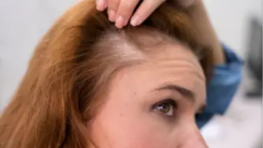 ¿Se te cae mucho el cabello? Experta en hormonas revela la dieta milagrosa contra la alopecia ¿Se te cae mucho el cabello? Experta en hormonas revela la dieta milagrosa contra la alopecia