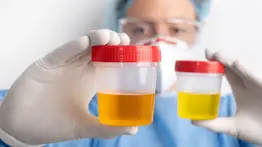 Salva tu vida: toma medidas urgentes si observas alguna de estas señales en la orina