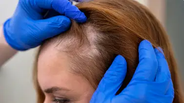 Un medicamento contra la artritis logra regenerar el cabello perdido: conoce esta revolución dermatológica Un medicamento contra la artritis logra regenerar el cabello perdido: conoce esta revolución dermatológica