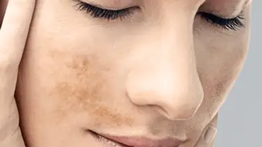 Reconoce los cuatro tipos de manchas que pueden aparecer en el rostro Reconoce los cuatro tipos de manchas que pueden aparecer en el rostro