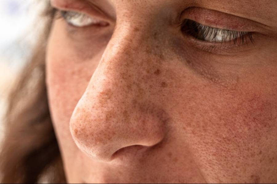 Reconoce los cuatro tipos de manchas que pueden aparecer en el rostro- Reconoce los cuatro tipos de manchas que pueden aparecer en el rostro